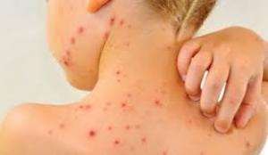 Rafila, despre epidemia de rujeolă: încurajăm părinţii să se prezinte cu copiii la vaccinare